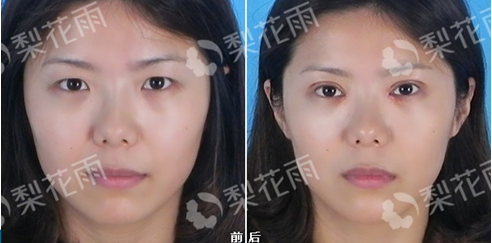 鹰嘴状切口内眦赘皮矫正术新成果