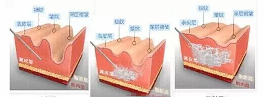 玻尿酸的工作原理:用注射的方法将玻尿酸注射到真皮层或皮下,达到